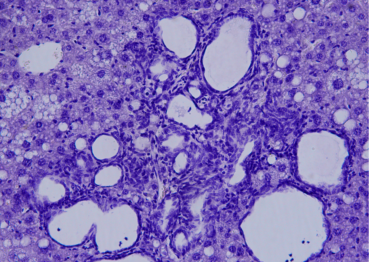 Colangiocarcinoma