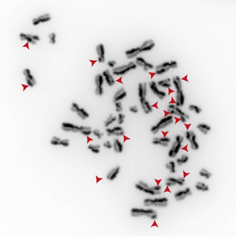 Cromosomas de células con mutaciones en el gen TOP3A que presentan numerosos intercambios SCE (Sister chromatid exchange).