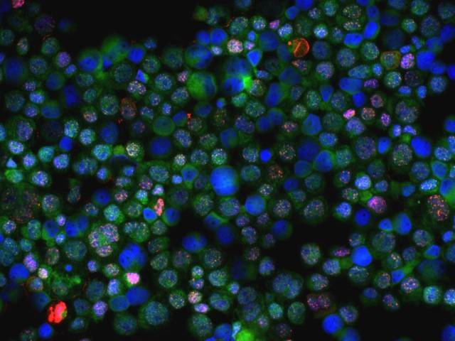 Descubren dos genes modificadores del riesgo de cáncer de mama y ovario 
