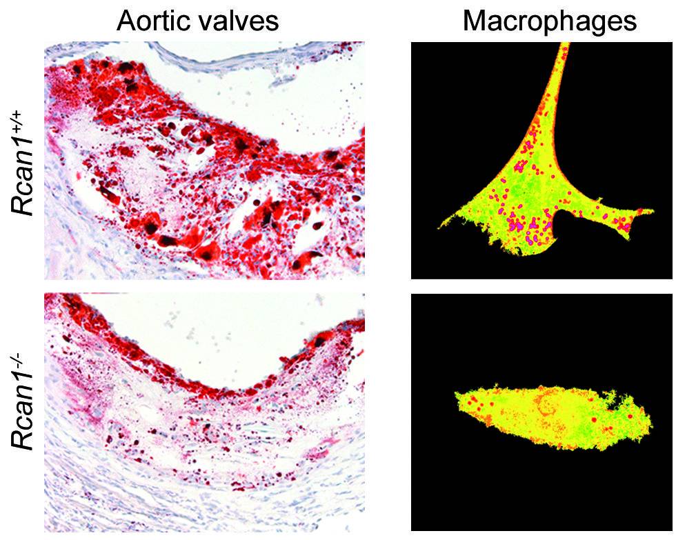 Descubren que la inhibición de una proteína podría mejorar la aterosclerosis