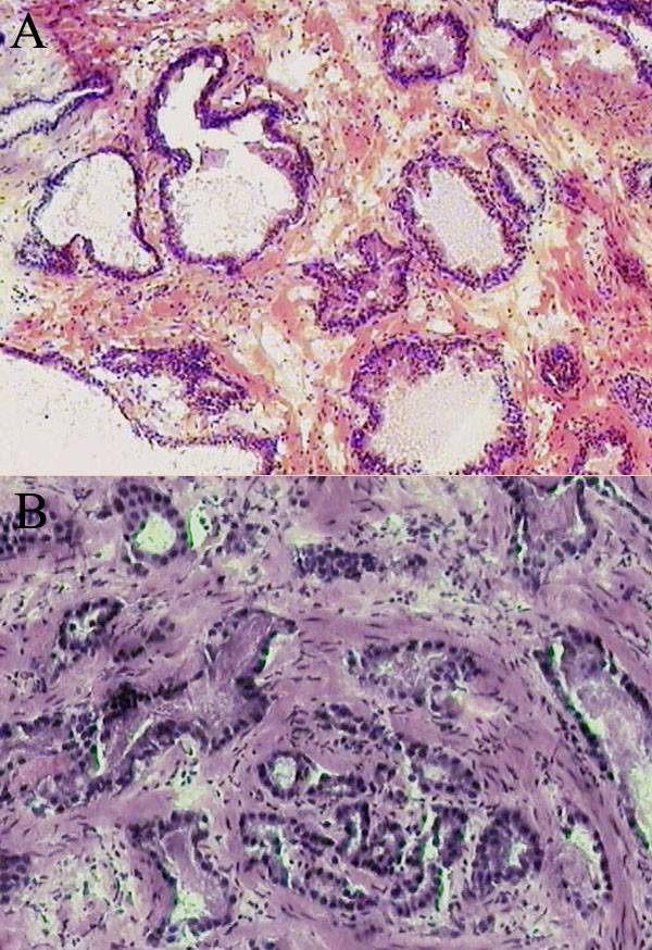 Descubren un nuevo marcador fundamental para el diagnóstico precoz del cáncer de próstata