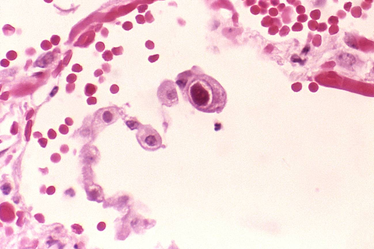 Desvelada una posible diana terapéutica contra los virus tipo herpes