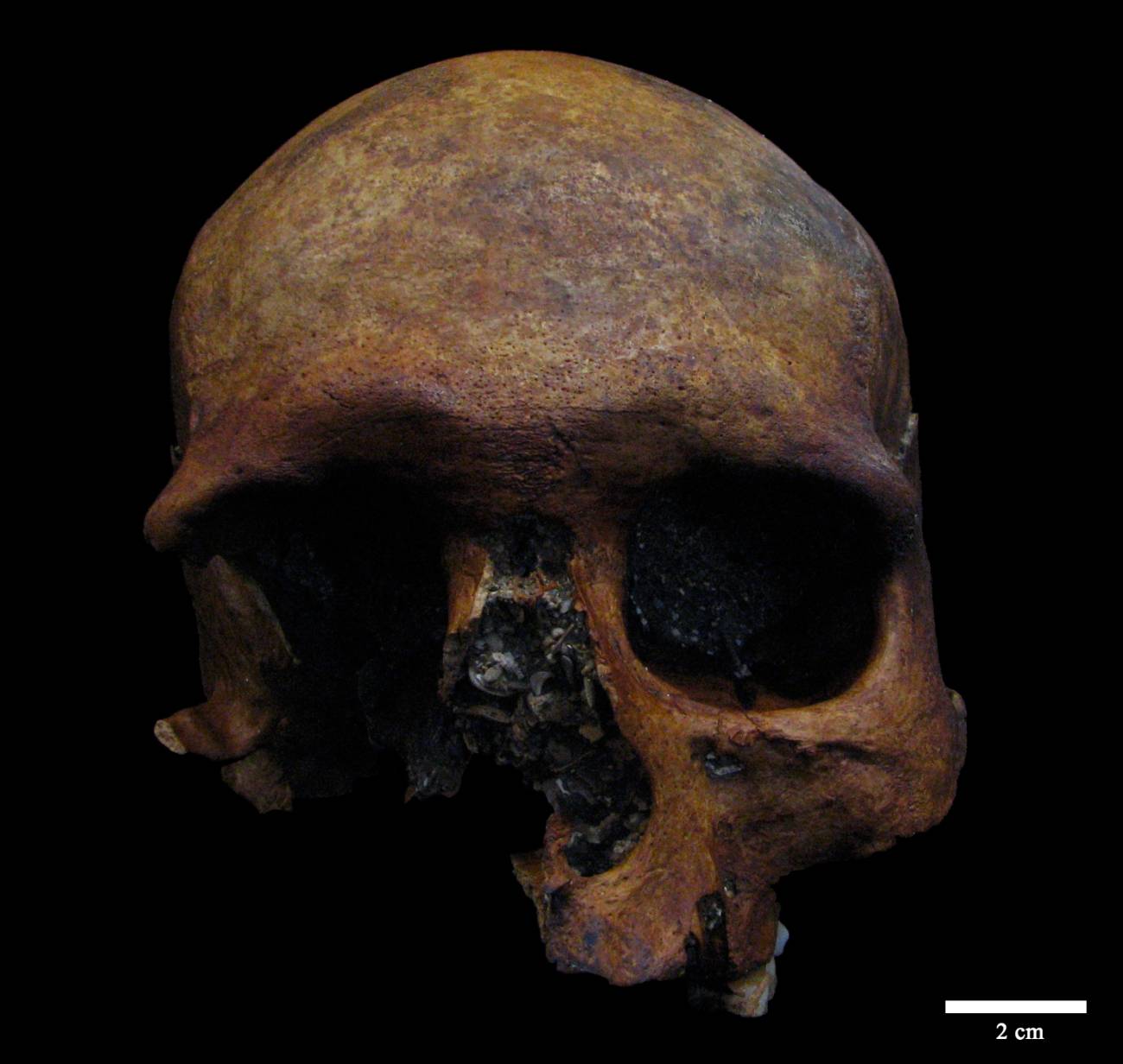 Detectado un caso de tumor craneal de época romana en la península ibérica