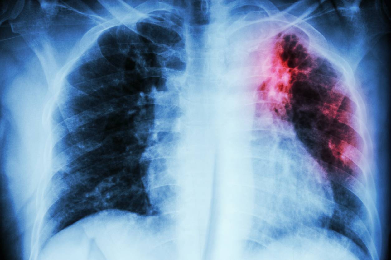 Detectan variantes genéticas inéditas de la bacteria que causa la tuberculosis