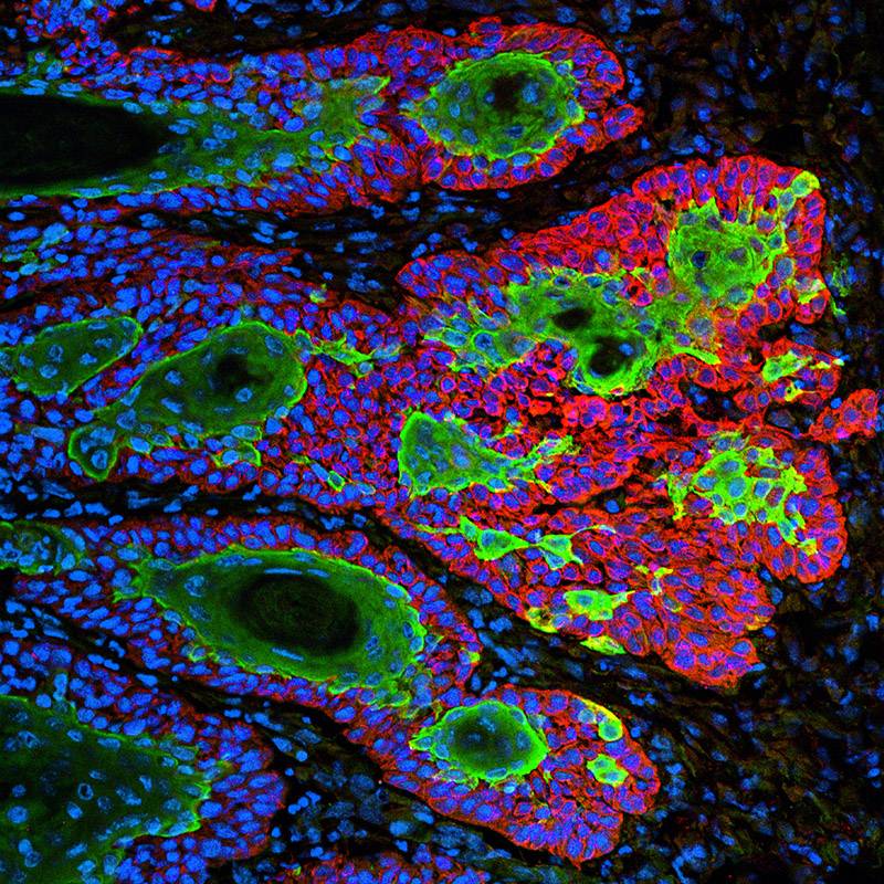 Carcinoma de células escamosas, un tipo muy común de cáncer de piel / Markus Schober and Elaine Fuchs, The Rockefeller University.