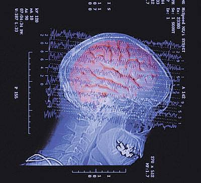 Dos estudios abren la puerta al uso del tratamiento del infarto cerebral más allá de las tres horas