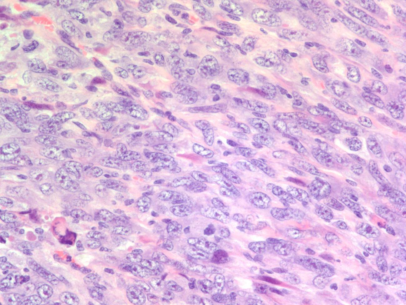 mesotelioma