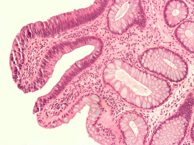 El cáncer colorrectal causa una de cada diez muertes por cáncer en España