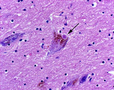 El origen del párkinson puede estar en el intestino