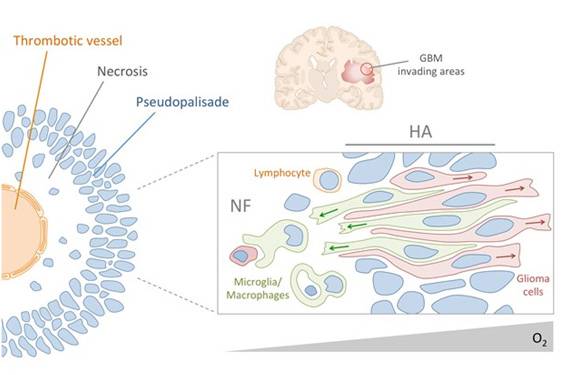 El sistema inmunitario contribuye a la capacidad invasora de los tumores cerebrales