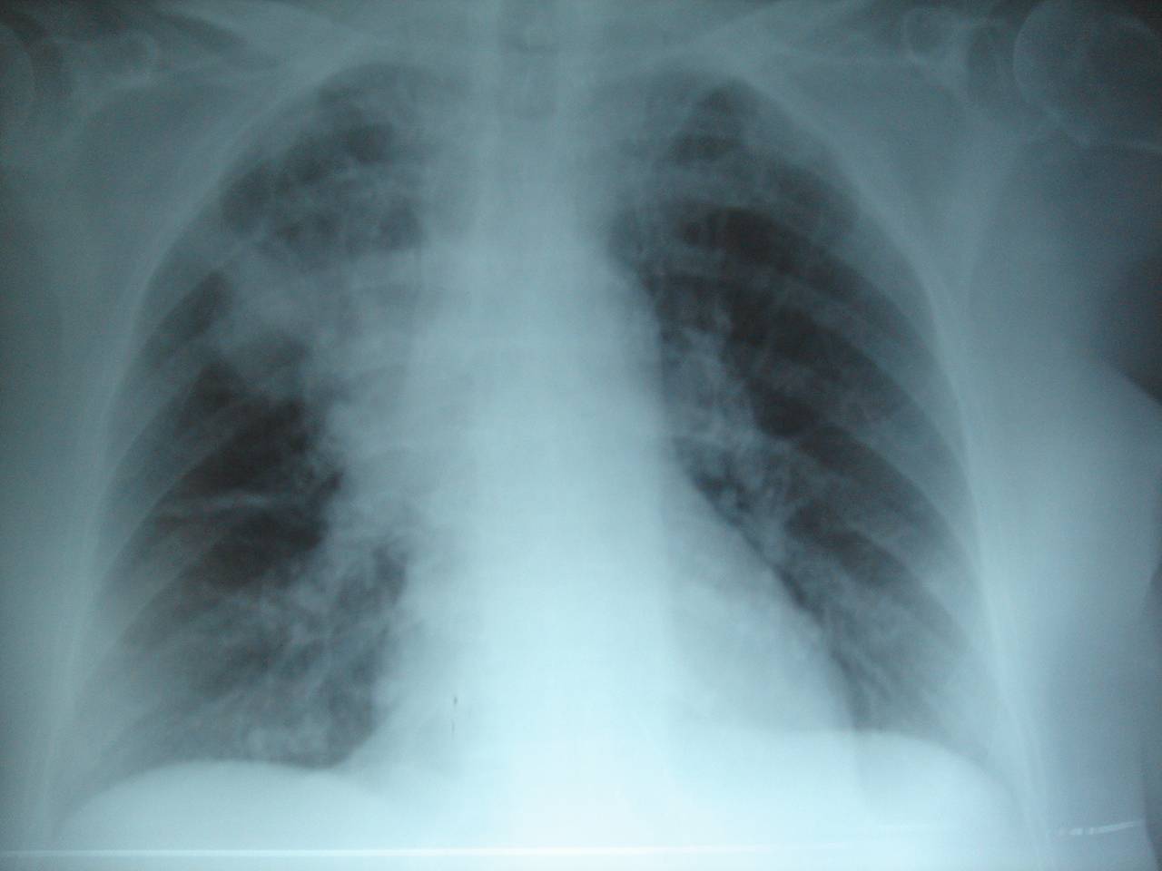 El tratamiento de cada paciente con fibrosis quística cuesta en torno a 6.000 euros anuales