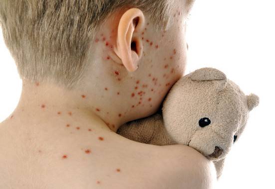 Niño infectado con sarampión