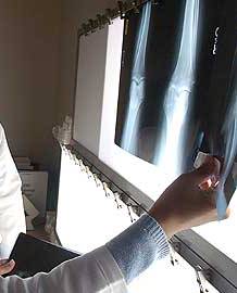 Establecen una correlación entre el riesgo de fractura ósea y la composición corporal en mujeres españolas