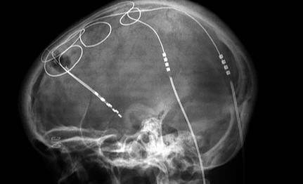 Estimulación cerebral profunda. 