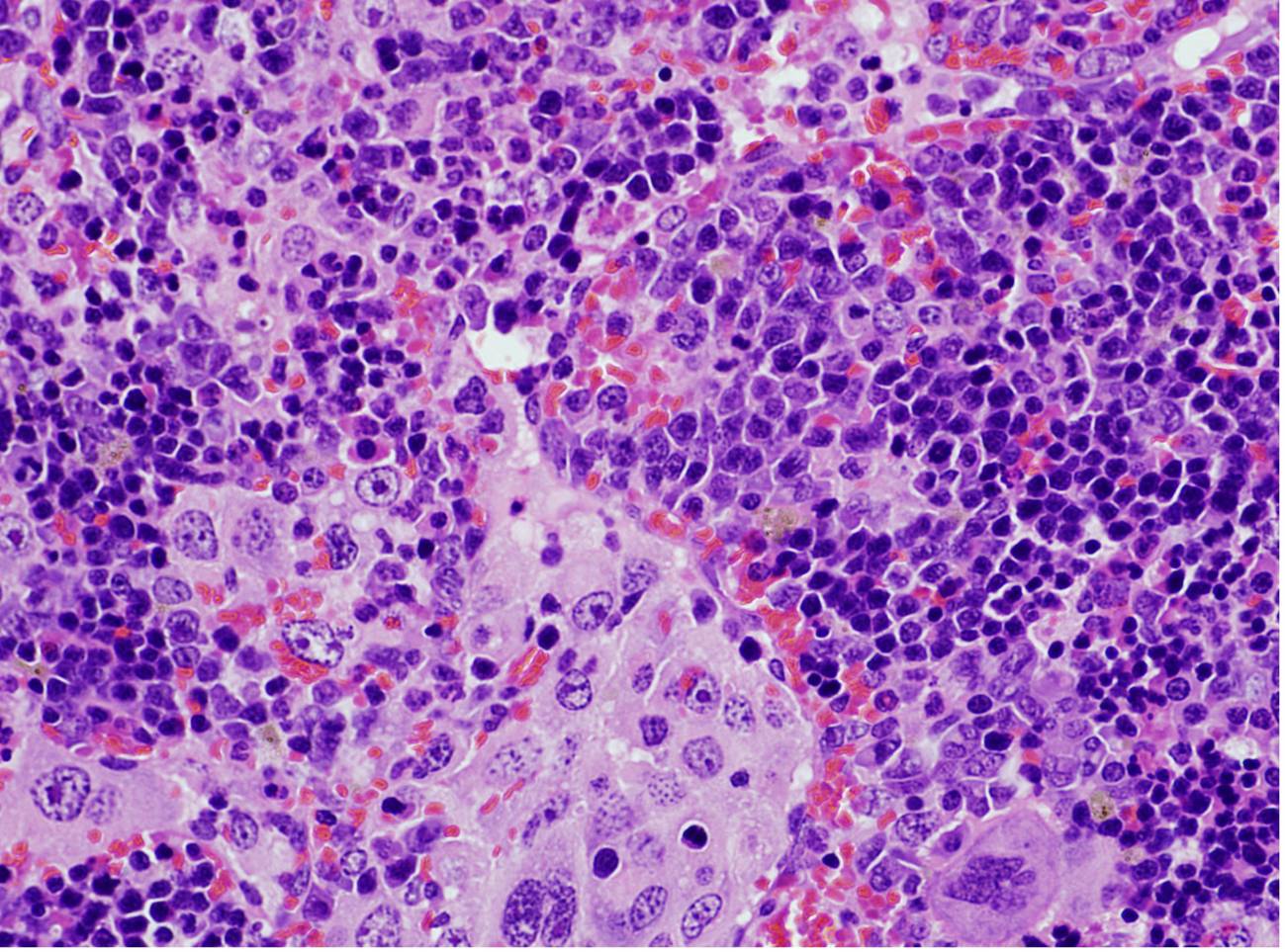 Hallada una mutación genética clave en la aparición de linfomas y en el cáncer de pulmón