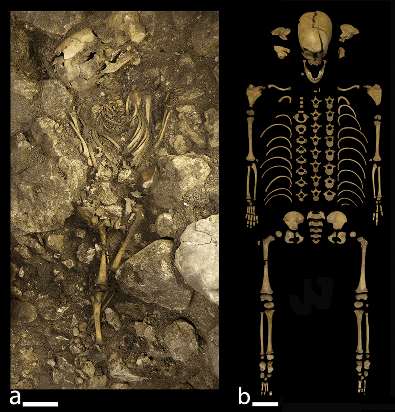 Hallan en Atapuerca un caso de raquitismo y escorbuto de hace 5.000 años