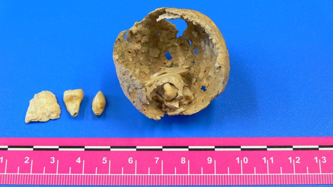 Hallan un tumor ovárico en el esqueleto de una mujer de la época romana 