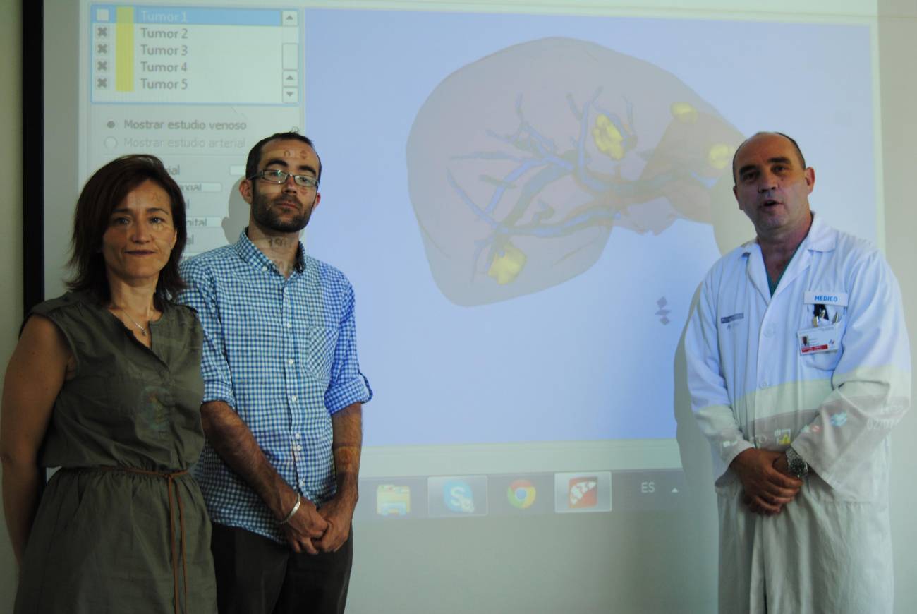 Hepaplan, nuevo 'software' para operar con precisión los tumores hepáticos 