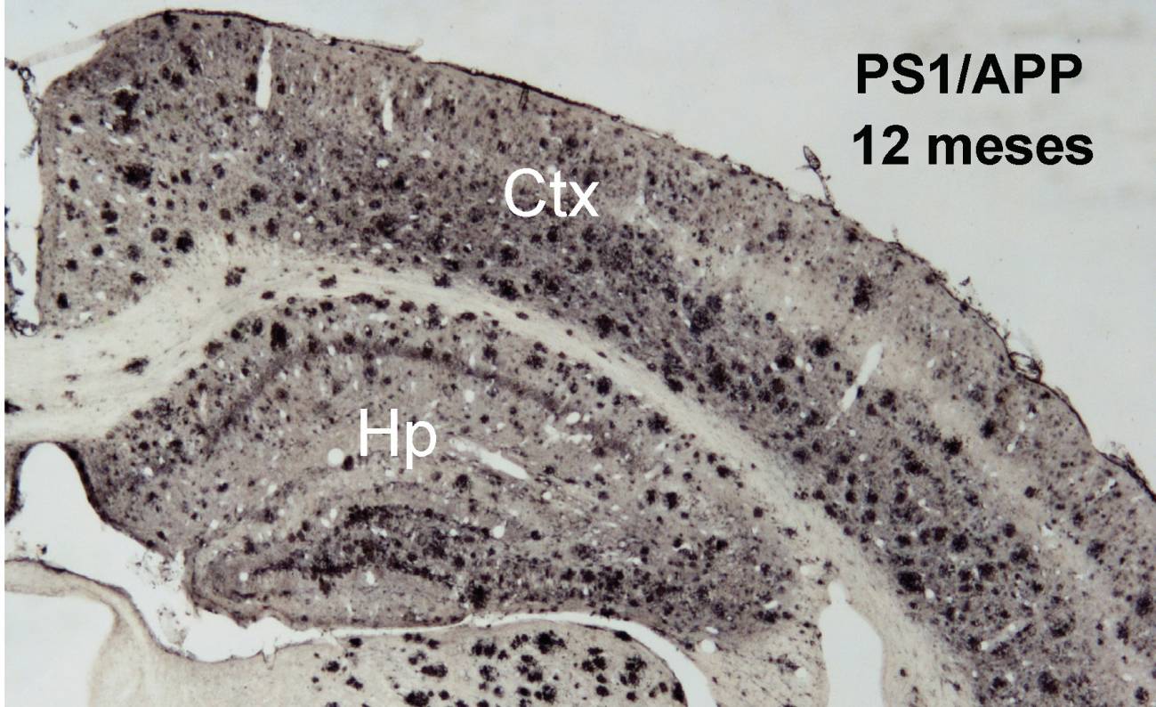 Identifican marcadores del Alzheimer que contribuirán al desarrollo de nuevos fármacos
