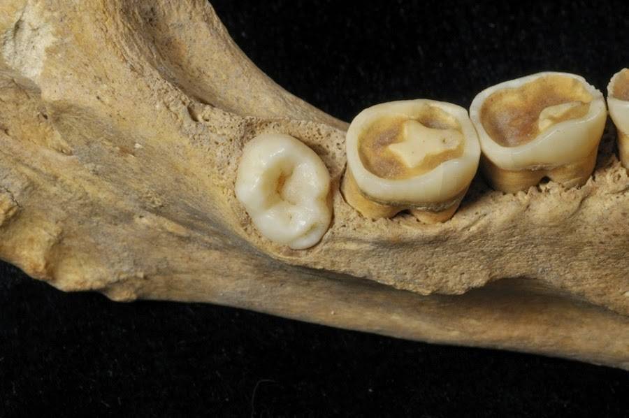 Identifican por primera vez un homínido de Atapuerca con un molar de más 