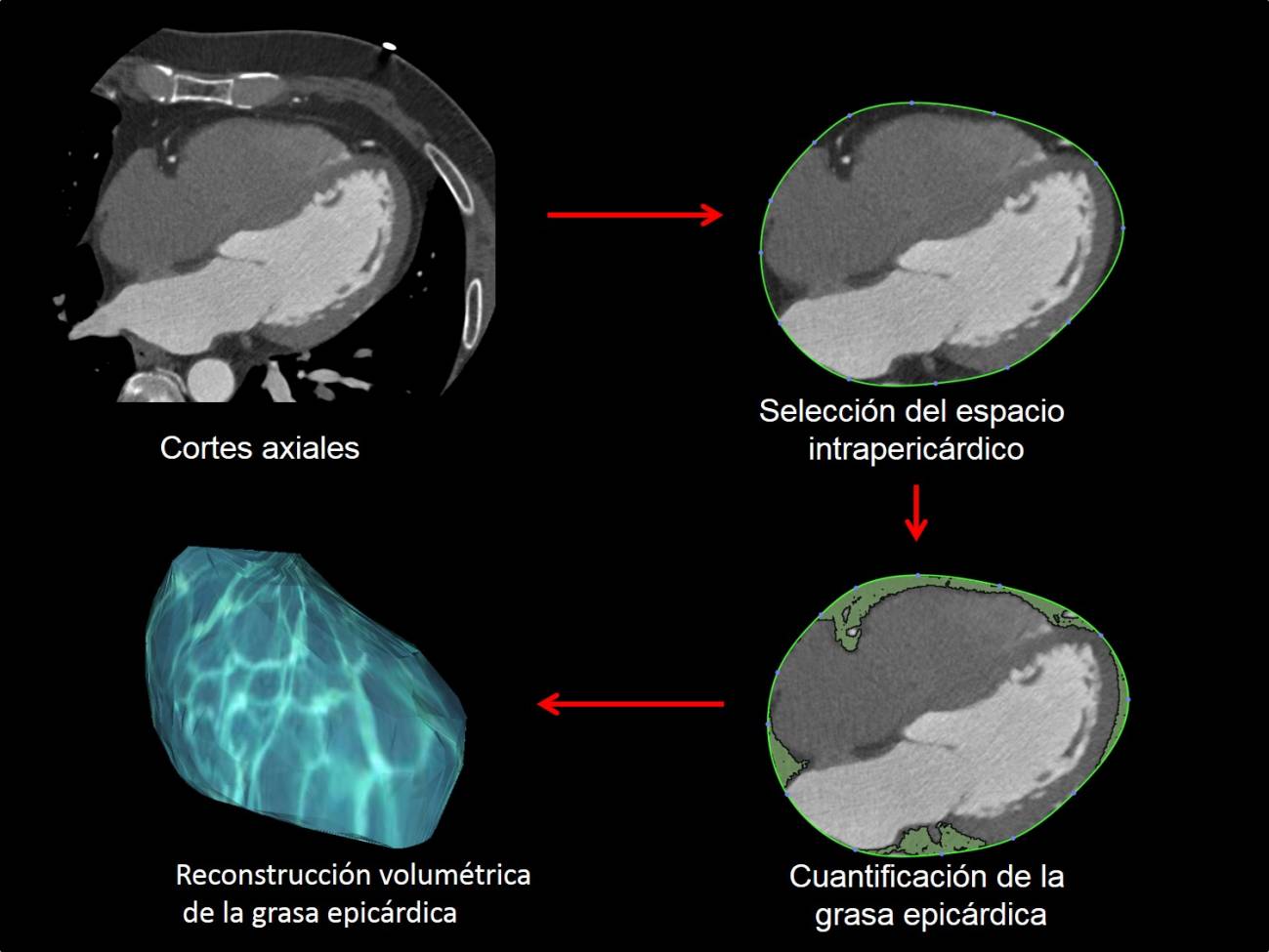Identifican un biomarcador no invasivo de la grasa epicárdica en diabetes