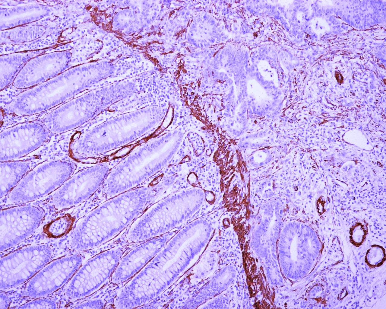 Identifican un centenar de biomarcadores útiles para predecir la evolución del cáncer colorrectal