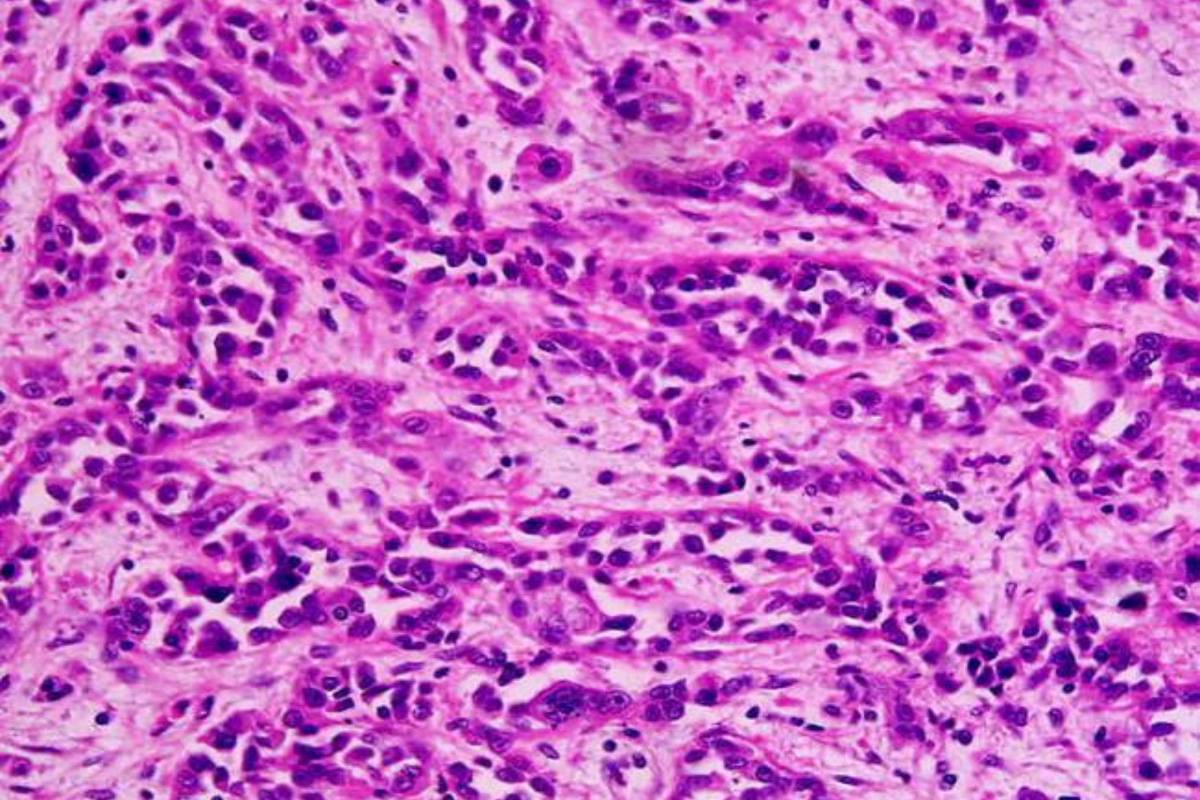 Adenocarcinoma de estómago. / Kwz-commonswiki