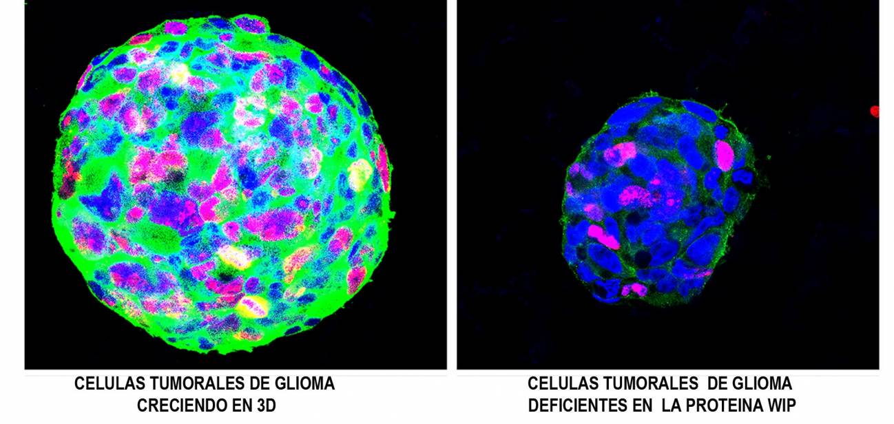 Identifican una proteína clave en la progresión de tumores cerebrales