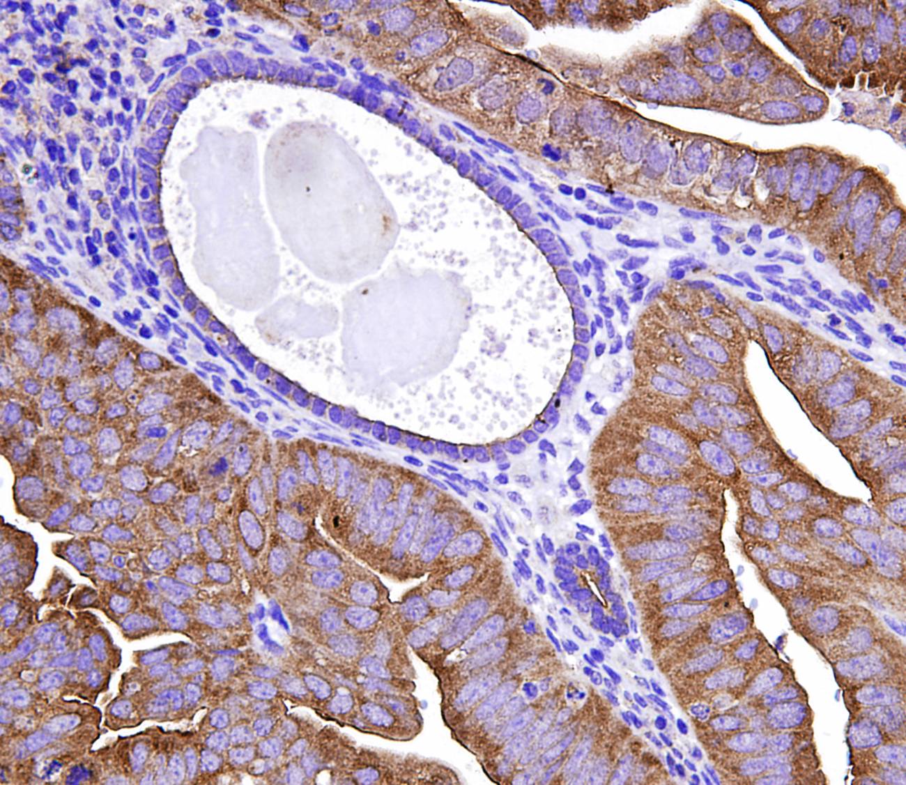 Identifican unos genes que permitirán el diagnóstico ambulatorio de cáncer endometrio 