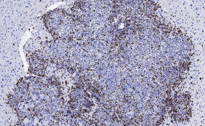 Inmunoterapia y un inhibidor hormonal para tratar tumores de colon agresivos