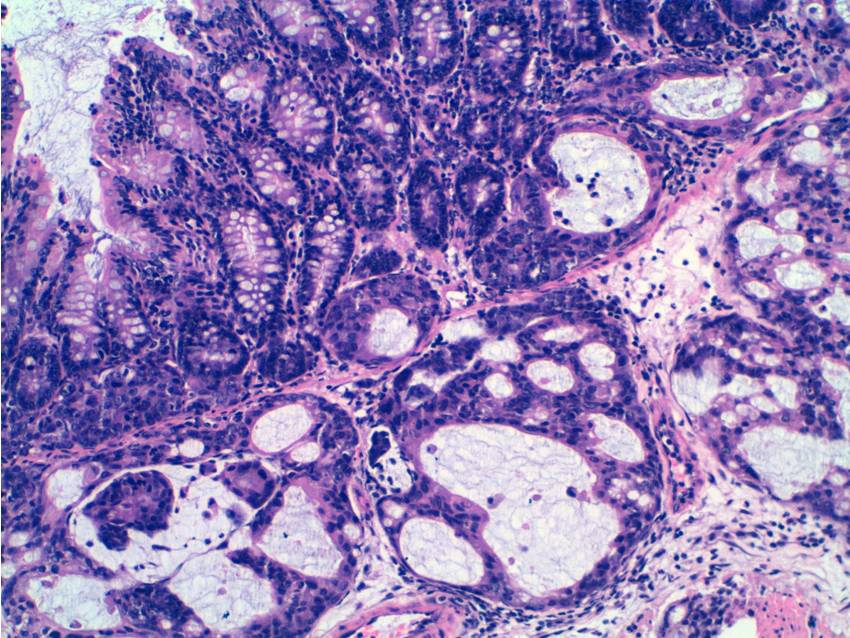 Tumor-colon-enoxacina