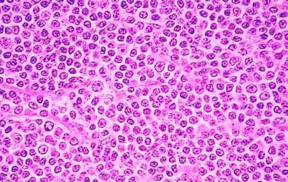 Investigadores españoles logran descifrar los primeros genomas completos de la leucemia linfática crónica
