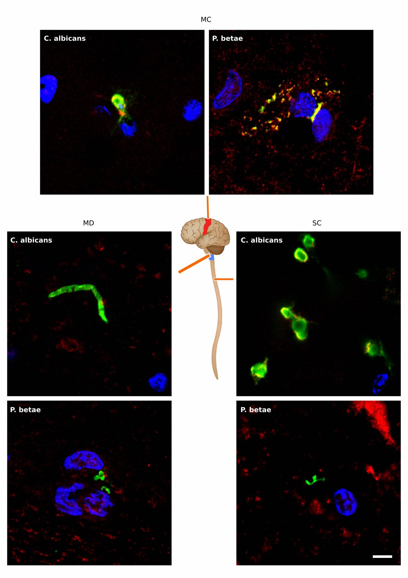 Investigadores españoles relacionan la ELA con hongos en el cerebro