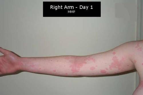 Investigadores internacionales discutirán en  Sevilla los últimos avances en el angioedema