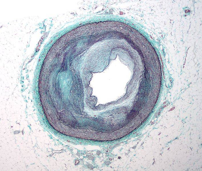 La contaminación acelera el proceso de la ateroesclerosis 