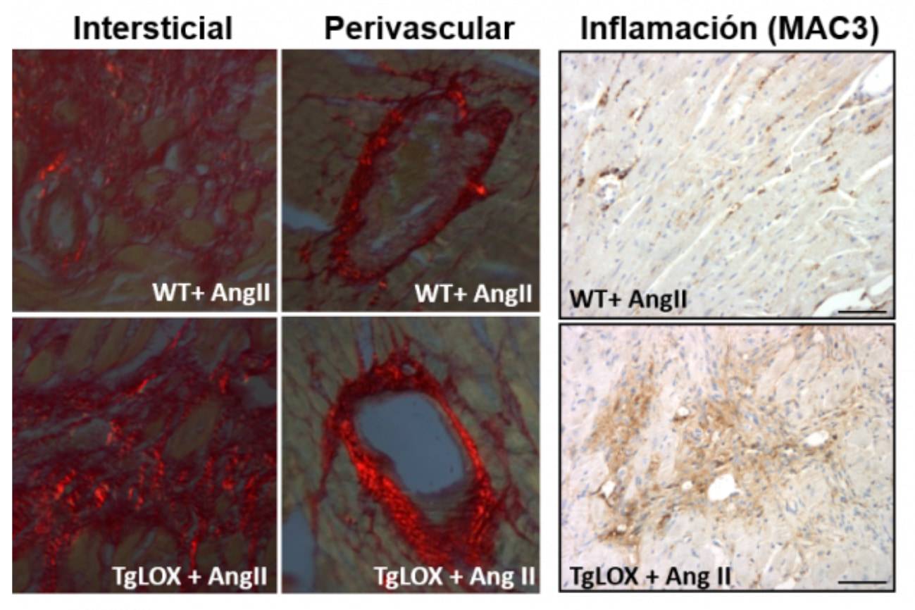 En el miocardio de los ratones transgénicos para la lisil oxidasa (TgLOX), la administración de Angiotensina II (AngII) aumenta el nivel de colágeno maduro (visualizado como refringencia roja) frente a los animales normales (WT). Los animales transgénicos presentan además mayor inflamación (paneles de la derecha)