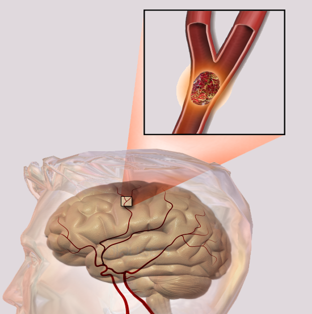 Representación de un accidente cerebrovascular. / Wikipedia