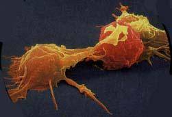 La inestabilidad cromosómica en un tumor es indicio de posibles recaídas