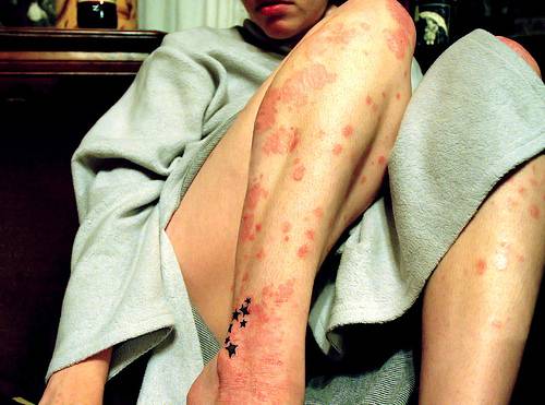 La psoriasis afecta de forma grave la calidad de vida del 22% de los pacientes