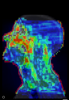 Visualización de la simulación de las dosis recibidas por un paciente oncológico