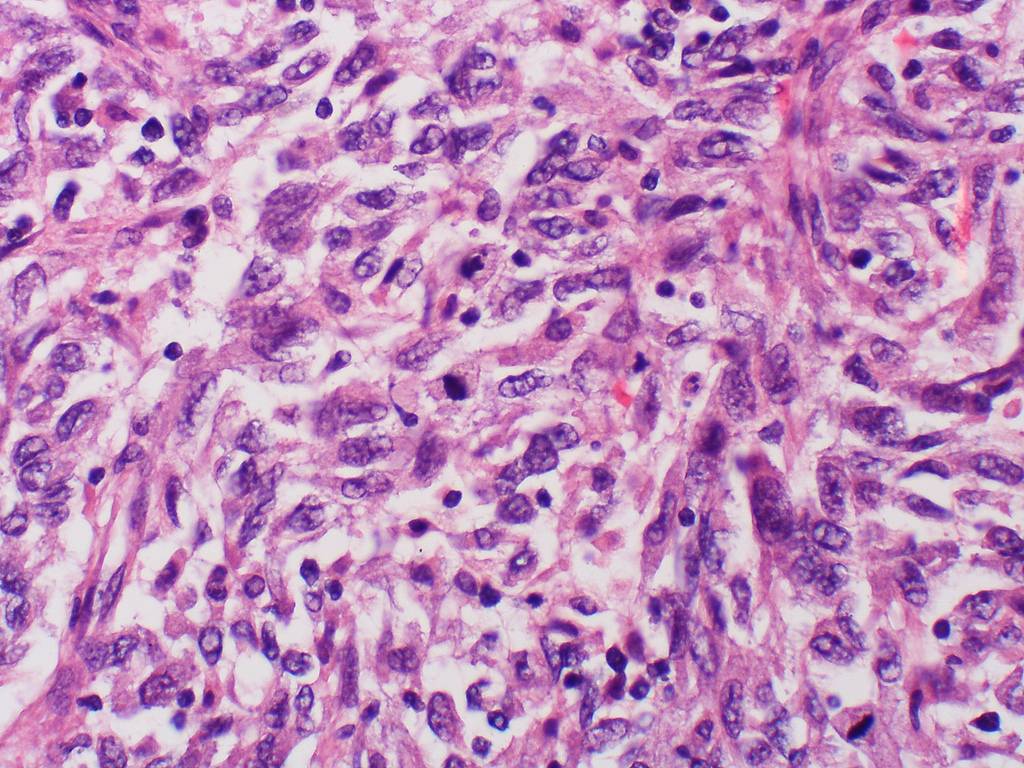 Células metastáticas de malanoma