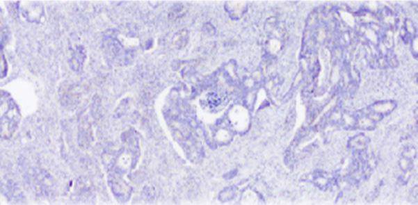 Cáncer de colon