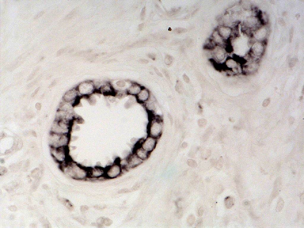 Las citoquinas pro-inflamatorias podrían mejorar el diagnóstico y el tratamiento del cáncer de próstata 