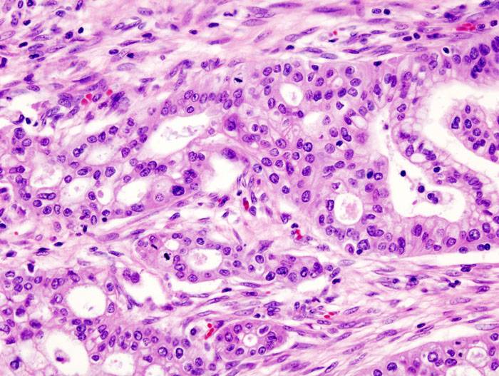 Cálulas cancerígenes de cáncer pancreático./ Wikipedia