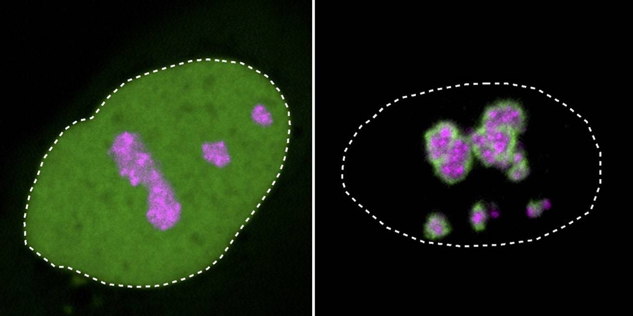 Los condensados de proteínas causan muchos tipos de enfermedades genéticas