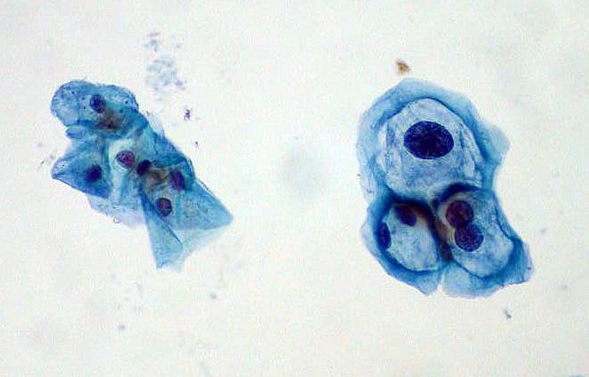 Los hombres con VIH presentan altas tasas de infección por papiloma en boca, ano y pene