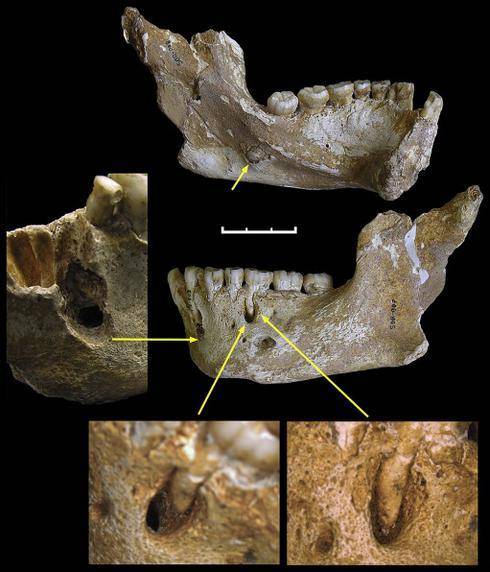 Marcas en los dientes que demuestran el uso preferente de la mano. / PLoS One