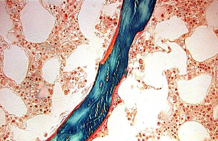 Los pacientes con VIH sufren más la osteoporosis