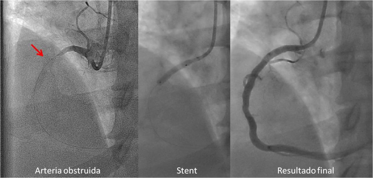 Los stents con fármaco mejoran la supervivencia en infarto agudo de miocardio