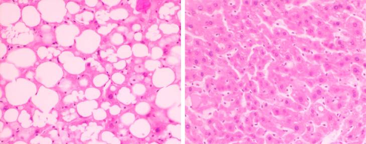 Suplementos adelgazantes y daños hepáticos